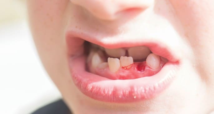 Knocked Out Teeth