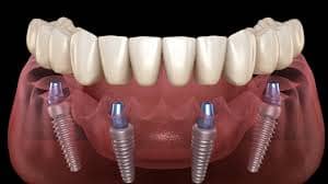 all in 4 dental implants Chicago