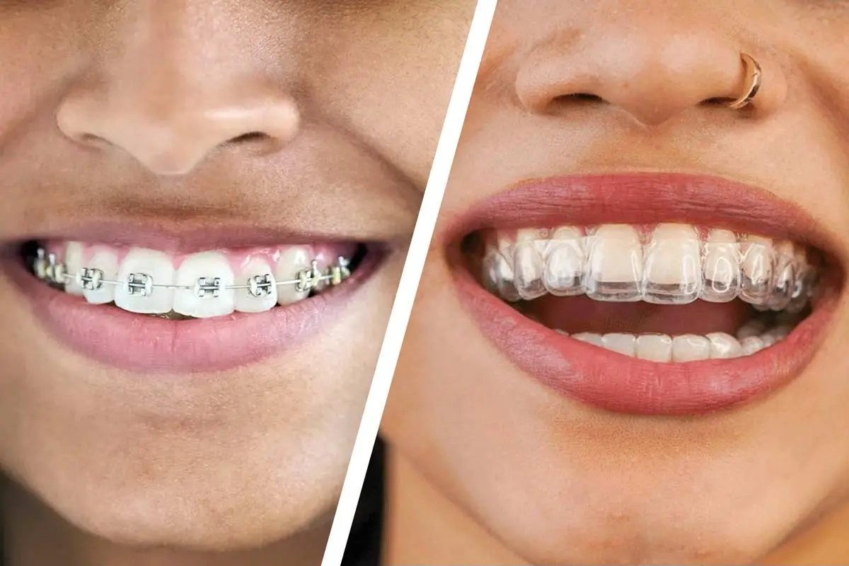Invisalign vs Braces