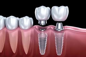 dental implants in chicago