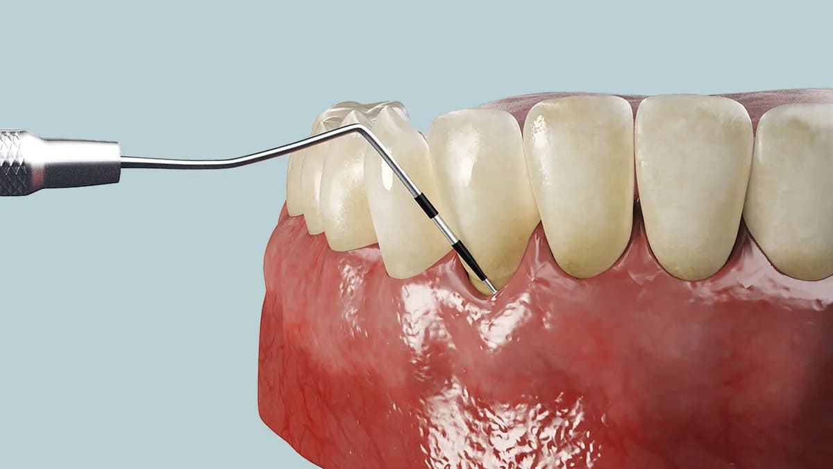 periodontitis-testing