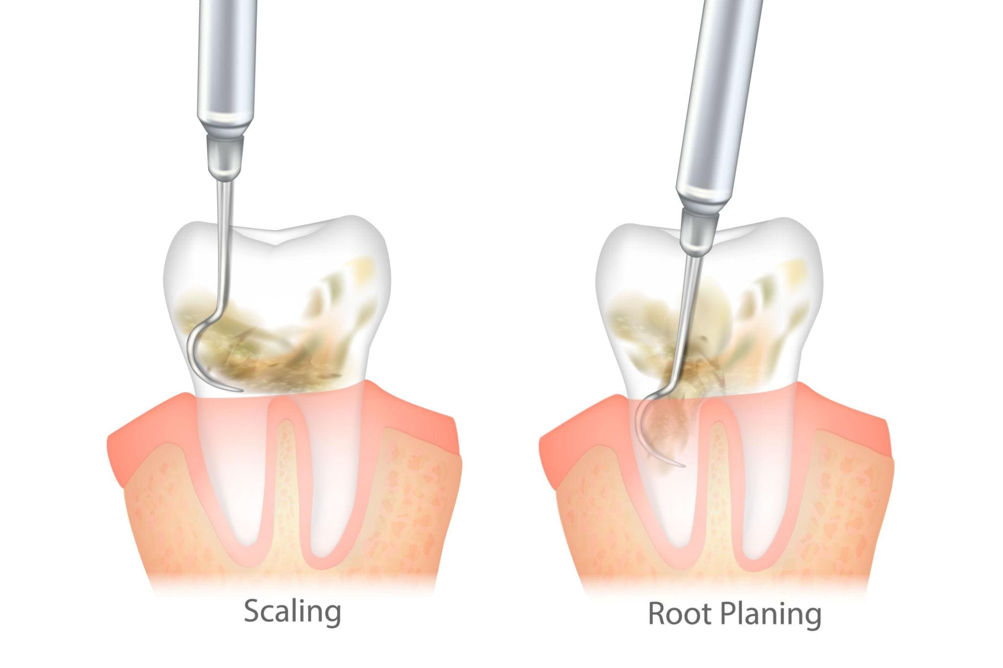 Scaling and Root Planing Expectations After Deep Cleaning  