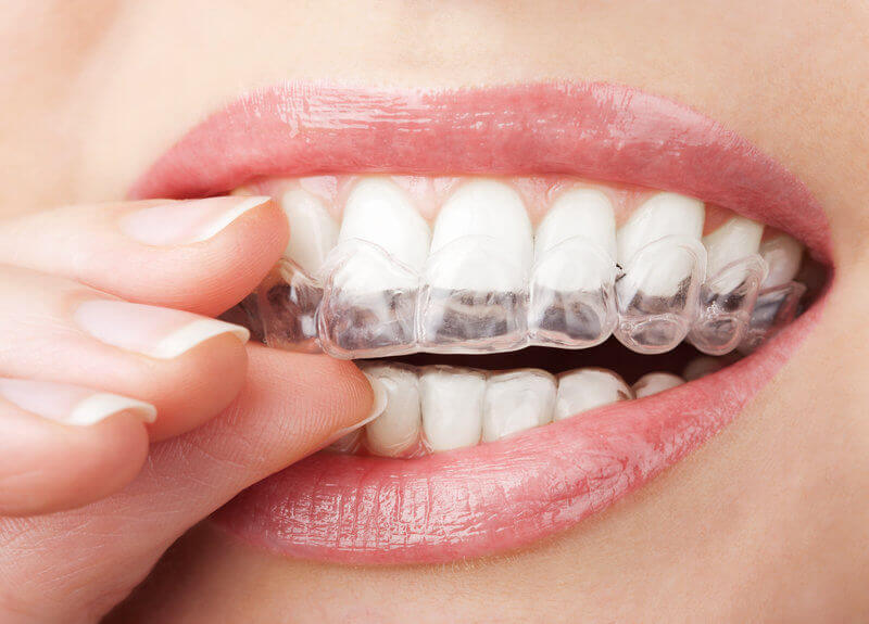 Invisalign Candidacy Checklist: Who It’s For and What to Ask at Your Consult
