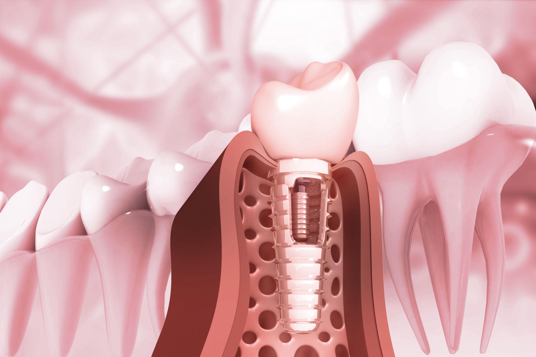 How Long Do Dental Implants Last?Longevity an|d Maintenance