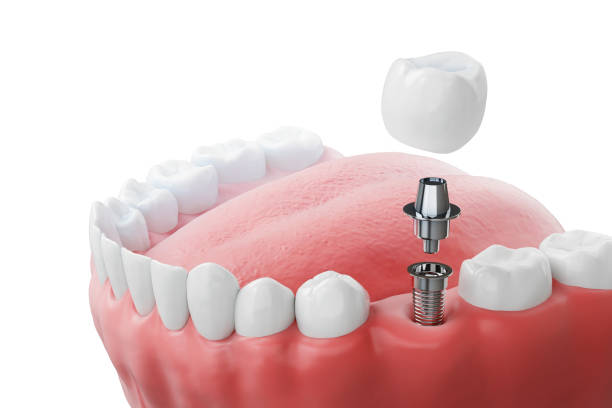 dental implants timeline